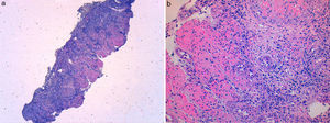 Esophagic mucosa with ulceration (a – HE 40×) and endothelial cell with nuclear inclusion suggestive of viral infection (b – HE 200×).
