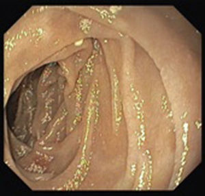 Initial upper endoscopy showing a discrete attenuation of villous pattern of the second portion of the duodenum.