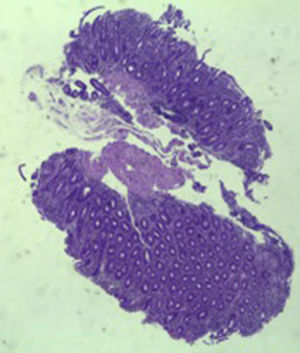 Small intestinal biopsy showing villous atrophy and chronic lymphocytic infiltration of the lamina propria (hematoxylin and eosin, 4×).