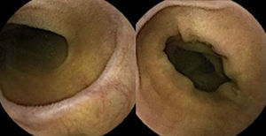Capsule endoscopy showing marked villous atrophy of the small bowel.