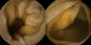 Follow-up capsule endoscopy showing normal small bowel appearance.