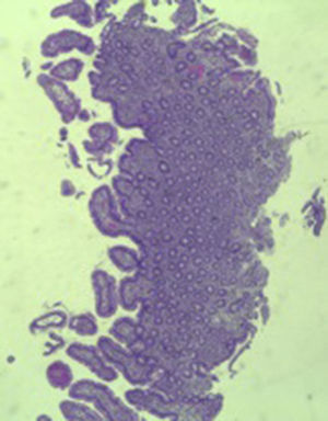 Histopathological image showing almost complete recovery of duodenal villi three months after discontinuing olmesartan (hematoxylin and eosin, 4×).