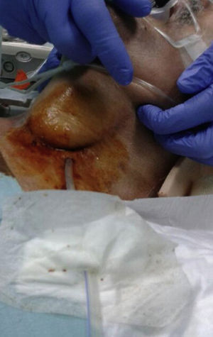 Image of the T-tube (Kerh-tube) placed in the cervical esophagus.