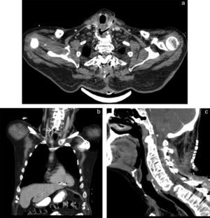 Computed tomography showing the T-tube placed in the cervical esophagus (arrows). (A) Axial view. (B) Coronal view. Cervical computed tomography confirmed the healing of the esophagus perforation the remaining orifice. Coronal view. (C).