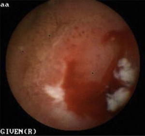 Patient with OOGIB with an actively bleeding jejunal ulcer.
