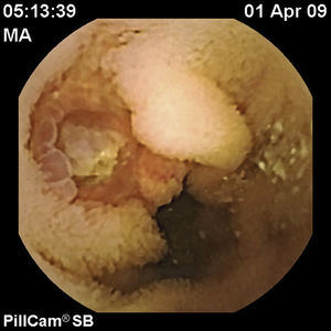 Ulcerated lesion in a patient with Kaposi's disease, it seems with high bleeding potential. A double-balloon enteroscopy was performed for local treatment, although the disease is diffuse in the small bowel.
