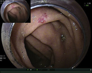 Cap-assisted enteroscopy for treatment of multiple angioectasias.