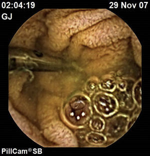 Follow-up capsule endoscopy after endoscopic treatment. Haemostatic clip without mucosal bleeding after a Dieulafoy's lesion was treated by oral balloon-assisted enteroscopy.