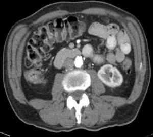 Computed tomography (CT) of abdomen and pelvis showing diffuse bowel wall thickening.