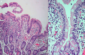 Small intestinal histological examination showing severe attenuated villi (A) with lymphoplasmmacytic inflammatory infiltrate in lamina propria and surface intraepithelial lymphocytosis (B) (HE, 400×).