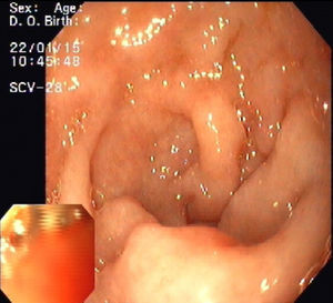 Upper endoscopy showing duodenal villous atrophy.