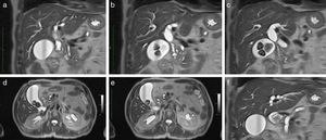 Magnetic resonance colangio-pancreatography images showing cystic structures in duodenopancreatic groove (a, b, d and e), pancreas divisum (a–c) and enlarged Wirsung (f).