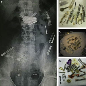Twenty-nine year-old prisoner male admitted for voluntary ingestion of multiple metallic foreign bodies. Before endoscopic intervention (A), abdominal radiograph shows multiple metallic objects scattered throughout the gastrointestinal tract. After endoscopic retrieval (B–D): multiple screws, nails, keys, finger ring, pieces of a metallic TV antenna and razor blades were retrieved. Patient was discharged with uneventful outcome.