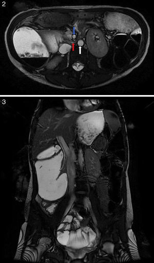 Abdominal magnetic resonance imaging showing compression of the duodenum between the aorta and the superior mesenteric artery.