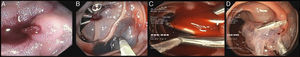 Push enteroscopy identified an intermittent spurting hemorrhage in the distal duodenum, initially misinterpreted as being a Dieulafoy's lesion (A). Endoclips were applied, with initial hemostasis, and tattooing was performed (B). A second enteroscopy identified an ectopic duodenal varix with active oozing. Cyanoacrylate injection was hampered by compromised visualization of the varix (endoclips and ongoing bleeding), but provided hemostasis (C).