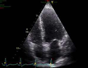 Echocardiogram.