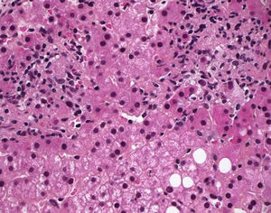 Liver histopathological examination: mononuclear cell infiltrate and epithelioid granuloma.
