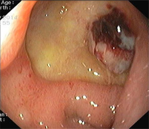 Endoscopic view of a large deep ulcer with a pulsatile visible vessel along the posterior aspect of the duodenal bulb.
