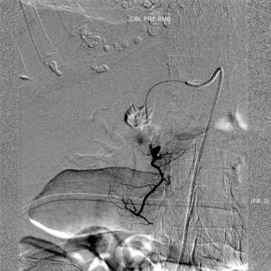 Selective angiography of the gastroduodenal artery before coil embolization.
