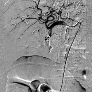 Selective angiography of celiac branch showing coils in the gastroduodenal artery resulting in hemostasis.