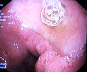 Endoscopic view of the ulcer with a coil located in the center of the previously bleeding vessel.