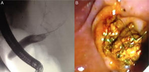 Endoscopic retrograde cholangiopancreatography showed a native CBD dilatation with an intracoledocal filling defect of 30mm (A). After sphincterotomy and with help of Dormia basket it was possible to extract several small stones and an elongate biliary mold (B).