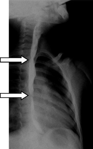 Esophagogram showing the exact location and extent of the stenosis (arrows).