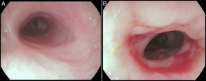 Endoscopic aspect of the esophageal mucosa after stent removal (A – distal stenosis; B – proximal stenosis).