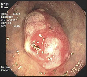 Mucosal prolapse polyp seen on colonoscopy – a 25mm erythematous lesion with erosion was found in the distal rectum.