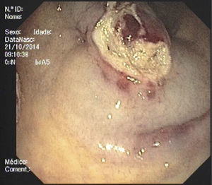 Endoscopic view after partial resection – extensive fibrosis in the base of the lesion was apparent after partial resection with diathermy snare.