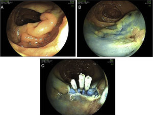 (A) Colic flat lesion diagnosed during colonoscopy with 40mm diameter; (B) submucosal lifting with a mixture of normal saline with adrenaline and methylene blue; (C) during piecemeal endoscopic mucosal resection a perforation was visualized and closed with 3 clips.
