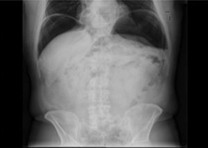 Plain Abdominal radiography documenting pneumoperitoneum after the iatrogenic perforation diagnosed during endoscopic mucosal resection and successfully treated with clips.