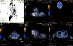 Positron emission tomography confirmed widespread metastases (A) of the lymph nodes (B) and in various other organs including the brain (C), bone (C), muscle (E) and skin/subcutaneous tissue (E).