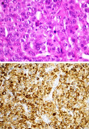 Histological analysis of the biopsy of the cervical node. Hematoxylin and eosin staining (A): poorly differentiated neoplastic cells with focal acinar formations, large nuclei exhibiting irregular chromatin clumping, size variation, and many mitotic figures are present, consistent with aggressive growth. Immunohistochemical staining (B): neoplastic cells express cytokeratin 8/18, cytokeratin CAM5.2, cytokeratin AE1/AE3, BCL10, β-catenin and alpha 1 antitrypsin.