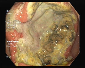 Endoscopic appearance of the irregular ulcer on the great curvature of the stomach.