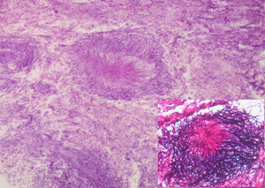 Clumps of basophilic filamentous Gram-positive bacteria (inset), in a rosette-like configuration, characteristic of Actinomyces infection (HE, 200×).