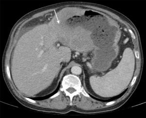 Abdominal computed tomography showing a gastric mass with 109mm×78mm of axial dimensions invading, by contiguity, the left lobe of the liver (white arrow).