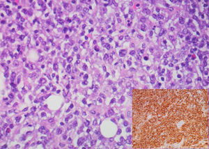 Diffuse large B-cell lymphoma. Diffuse growth pattern with large cells with pleomorphic nuclei and prominent nucleoli (HE, 400×). Diffuse expression of CD 20 (inset).
