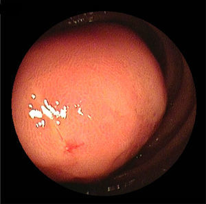 Double balloon enteroscopy showed an ulcerative subepithelial lesion protruding to the lumen of the proximal jejunum.