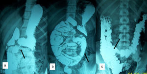Barium meal (a) shows abnormal position of DJ flexure to the right of midline; (b) shows clustered mildly dilated jejunal loops in the central and right half of abdomen; (c) shows normal cecal position.
