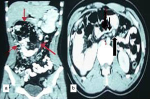 Contrast enhanced CT abdomen (a) coronal reformat shows clustered dilated jejunal loops in the central and right half of abdomen (red arrows). (b) Axial section shows abnormal orientation of superior mesenteric vein (bold black arrow) was seen ventral and to the left of superior mesenteric artery (thin black arrow).