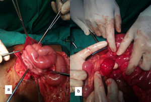 Intraoperative images (a) shows dilated jejunal loops within the opened hernial sac and (b) shows defect in the mesentery (site of herniation shown by the finger).