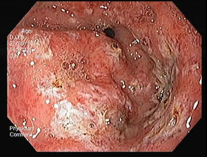 Gastric antral vascular ectasia – after APC treatment.