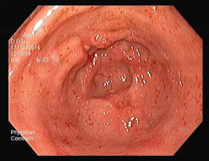 Gastric antral vascular ectasia – after EBL treatment (4 sessions).