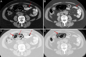 (A and B) The gas in the abdominal wall (arrows) at the level of the transverse colon and rectum-sigmoid colon is clearly visible on the computed tomography (CT). (C and D) CT scan in a lung window demonstrates more easily the presence of gas in the bowel wall.