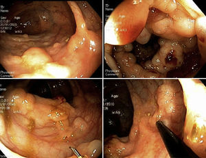 Colonoscopy showed multiple small submucosal cysts in the left colon, emptying with pinprick.