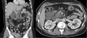 CT images showing large pancreatic cyst involving the surrounding tissues and vessels.