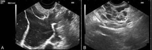 EUS image of the pancreatic cyst in the cephalic region (A) and body (B).