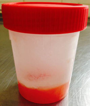 Liquid aspirated with FNA needle with chylous aspect.
