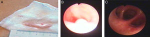 Case 1: (A) traqueal secretions obtained during the episode of respiratory failure; (B) second fibroscopy with polypoid tracheal lesion; (C) normal aspect of distal bronchi.
